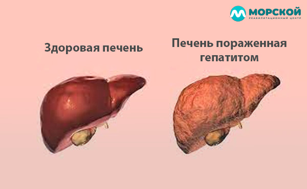 Сравнение здоровой и больной гепатитом печени